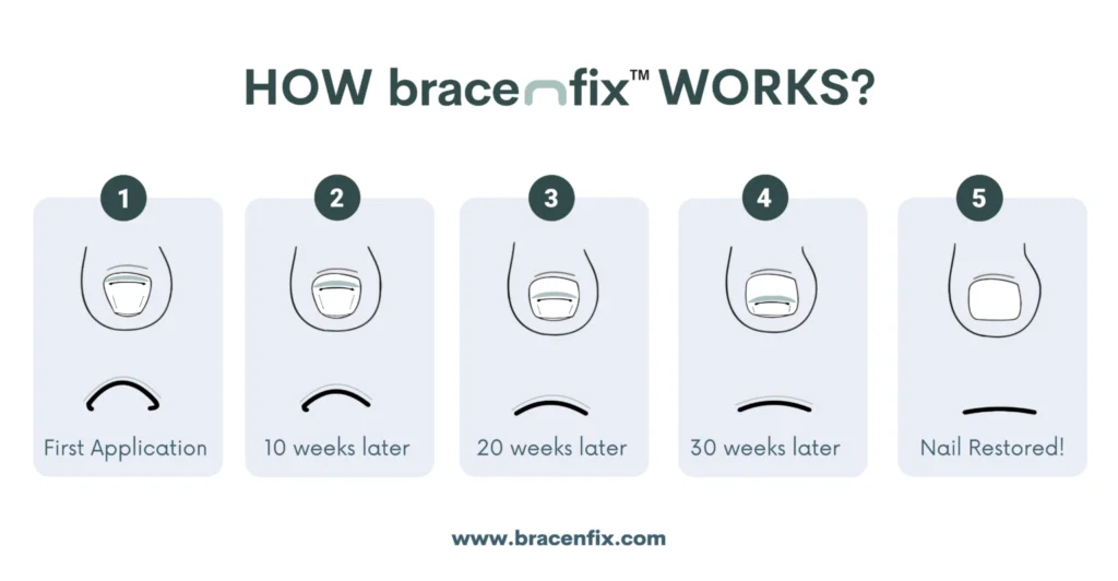 Infographic diagram of the brace-m-fix toenail correction system timeline, from first application to full nail restoration at 30 weeks.