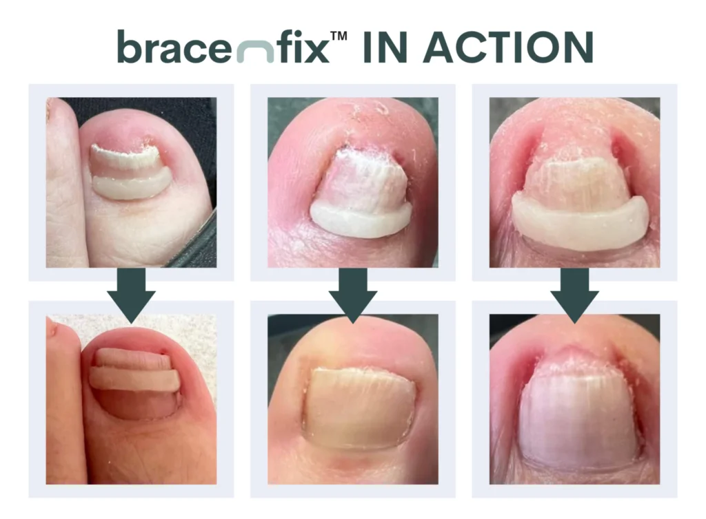 Brace m fix in action before and after comparison of curved toenail brace treatment.